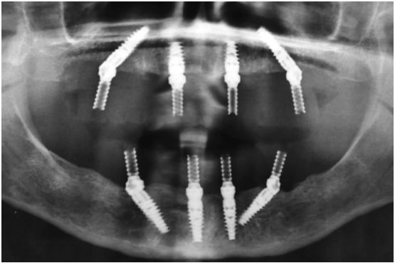 Dental Implants Dental Implants